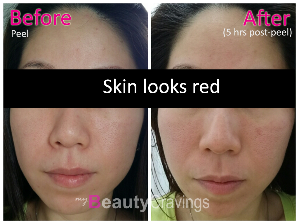 VI Precision Peel - Before vs After (5 hrs post-peel)
