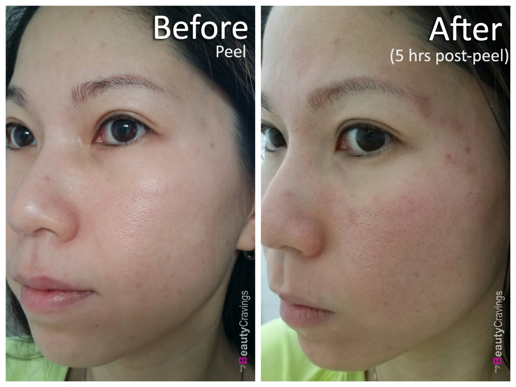 VI Precision Peel - Before vs After (5 hrs post-peel)