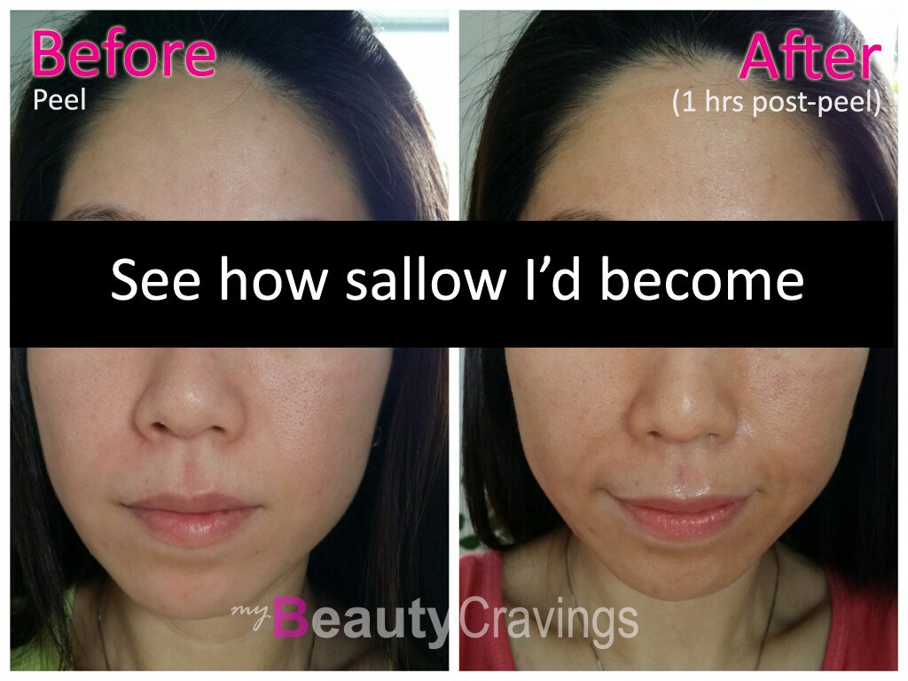 VI Precision Peel - Before vs Post-1hr (front)
