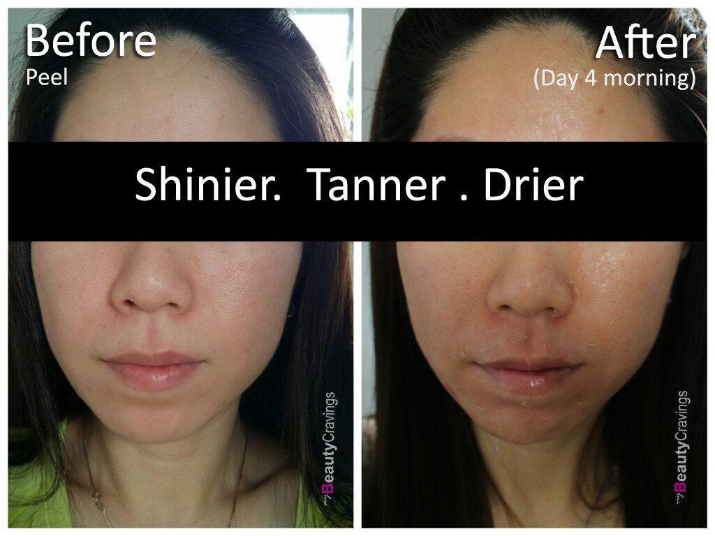 Day 4 - Morning (VI Precision Peel)
