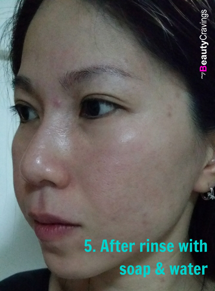40% Lactic Acid Peel MUAC - After