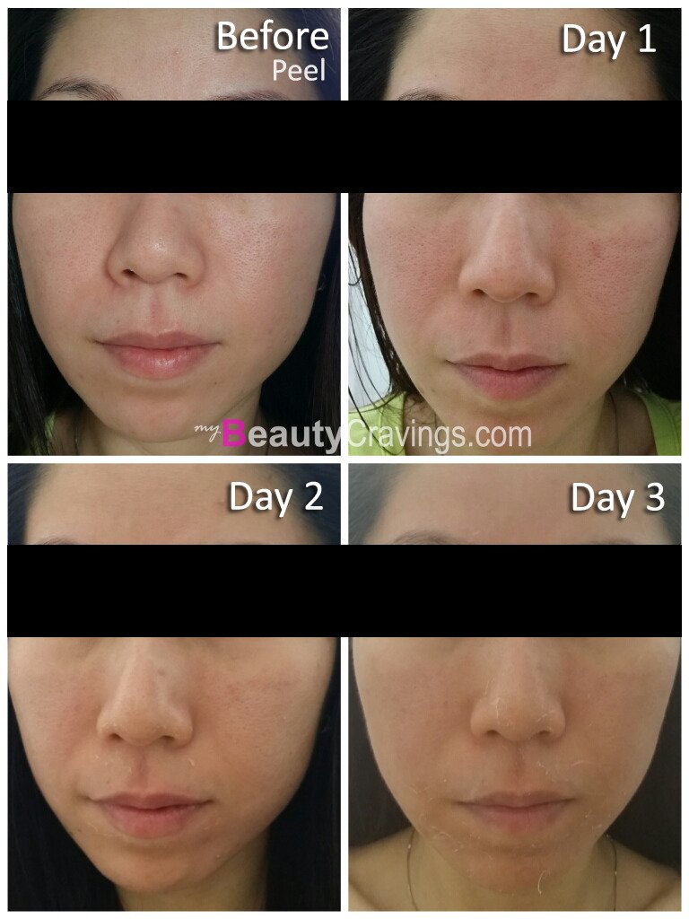 Day 1 to 3 (VI Precision Peel)