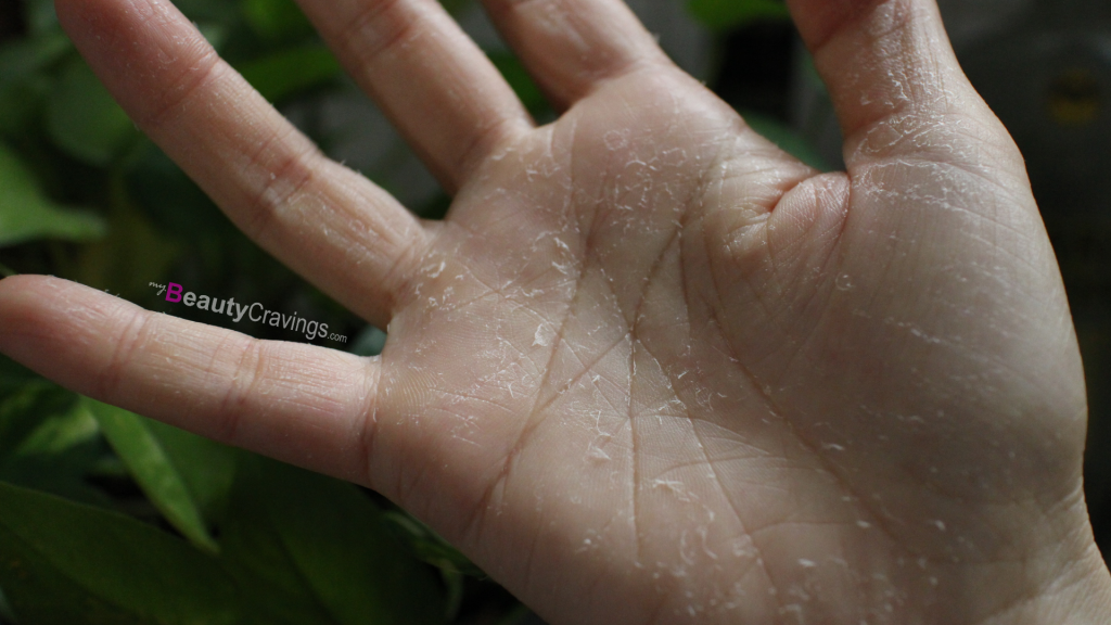 Right Palm peel first » myBeautyCravings