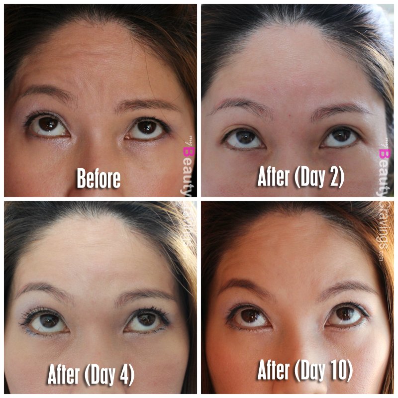 Before-After Botox (Forehead Wrinkles)