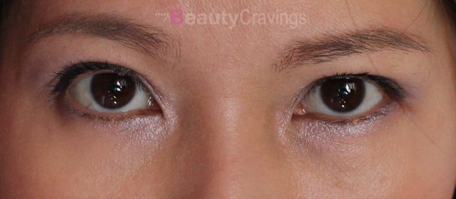 Tear Troughs