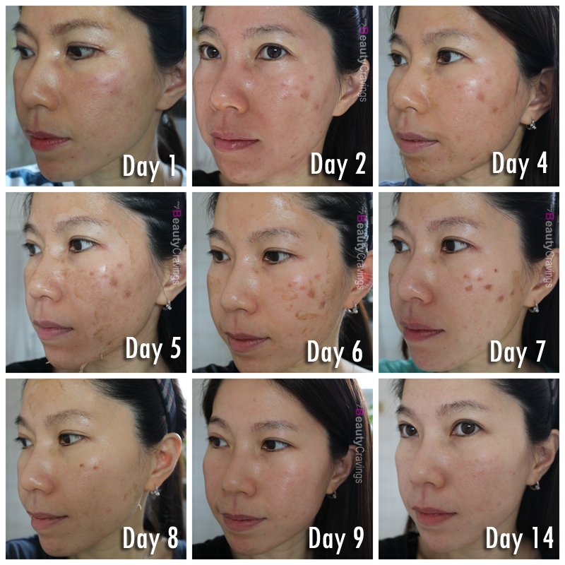 VI Precison Peel Recovery Photos