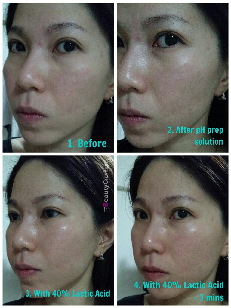 Lactic Acid Peel Before After