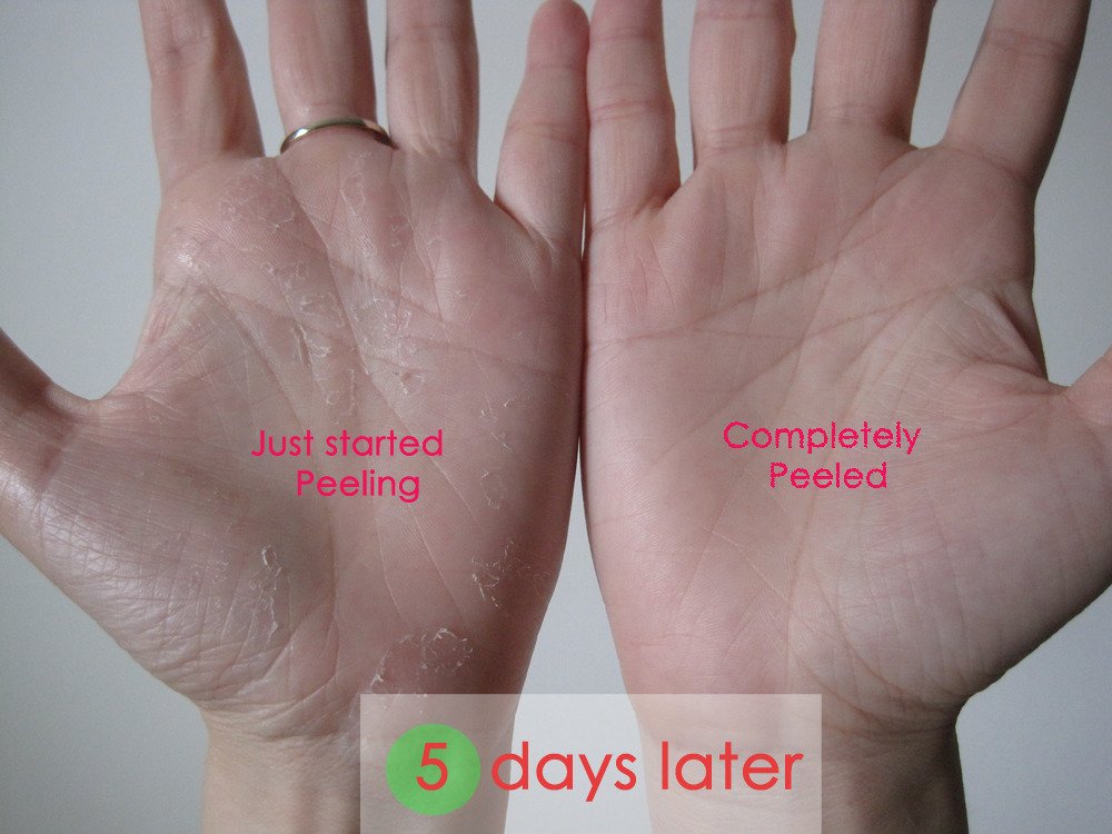 Left vs Right Palm (Peeling vs Peeled)