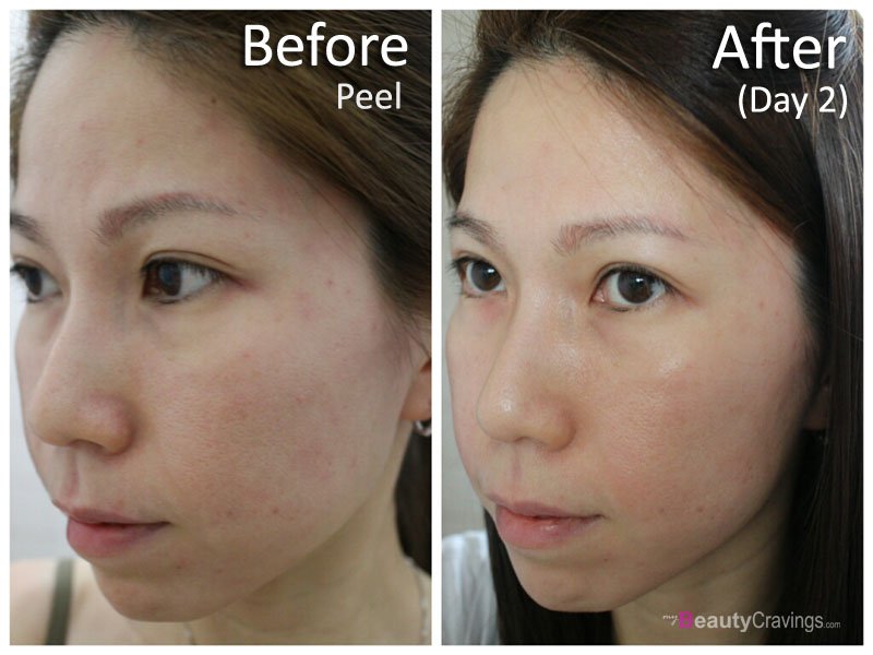 Day 2 - 40% Glycolic Acid (MUAC)