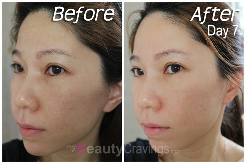 Before-After (Day 7) - Laser Facial by Gangnam Laser Clinic