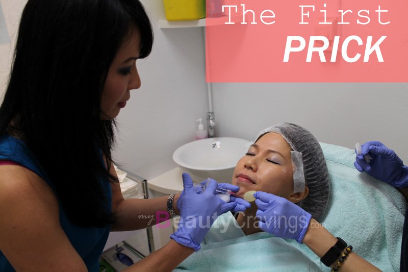 Chin Filler - The First Prick