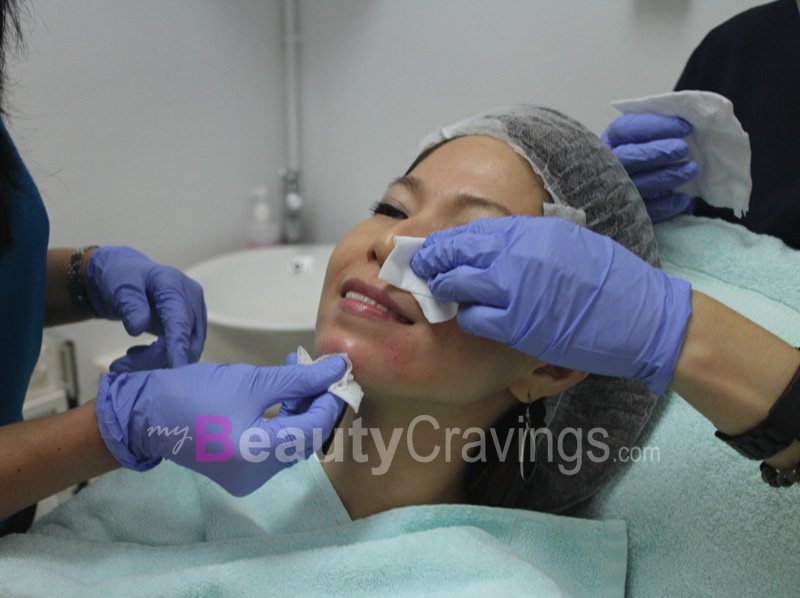 End of Filler Injection