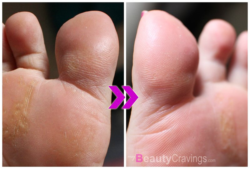 Skinlite Exfoliating Foot Mask