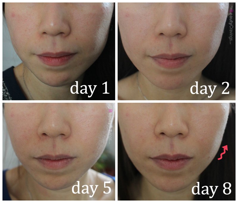 Before-After (Laser Facial at Gangnam Laser Clinic)