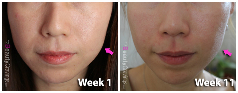 Before-After - can laser facial improve skin laxity?