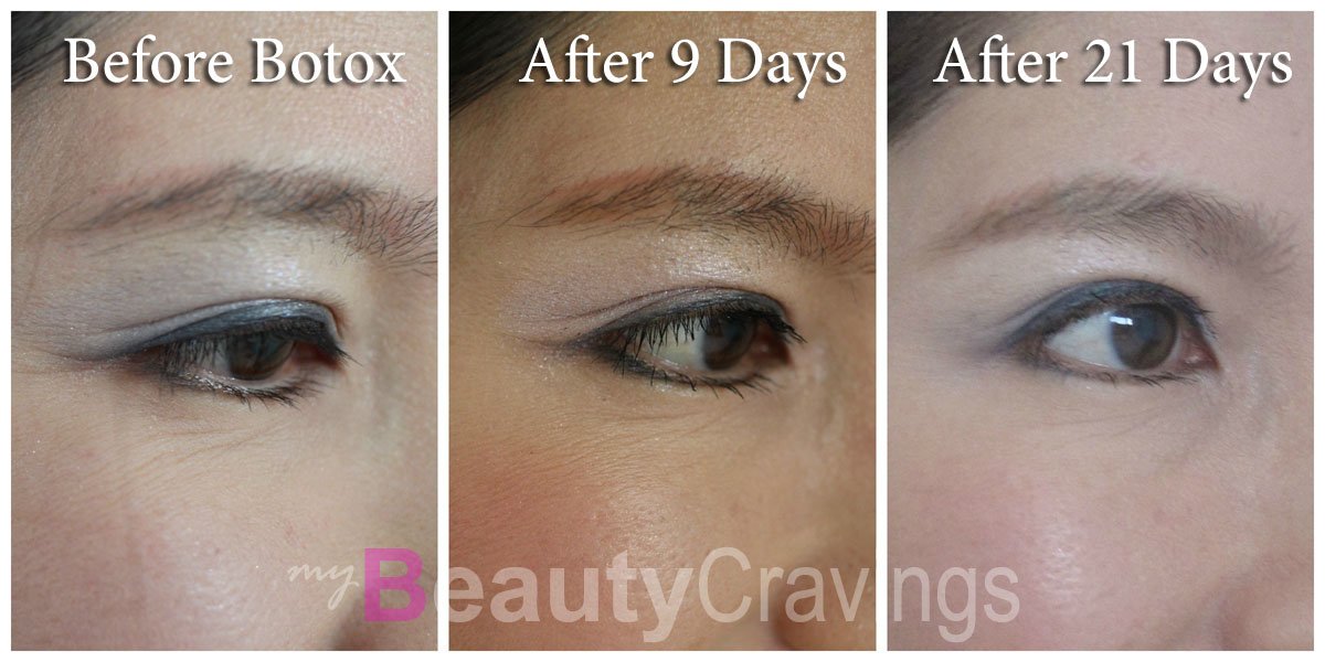 Under-eye wrinkles Botox Under-eye wrinkles Botox