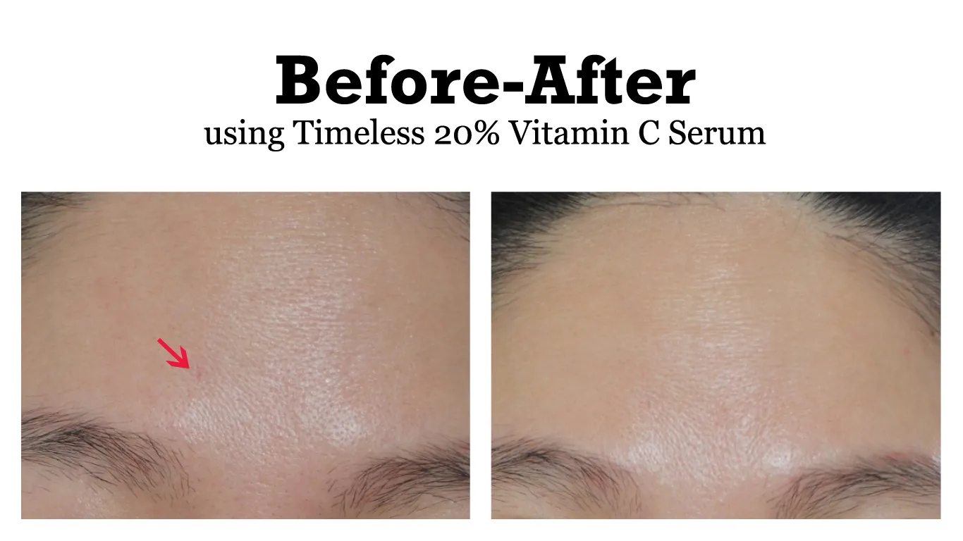 Repurchased Timeless Vitamin C Serum After 3 Years And Love This Brightening Elixir Even More Today Mybeautycravings